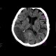 Ischemia, temporal lobe, third CT: CT - Computed tomography